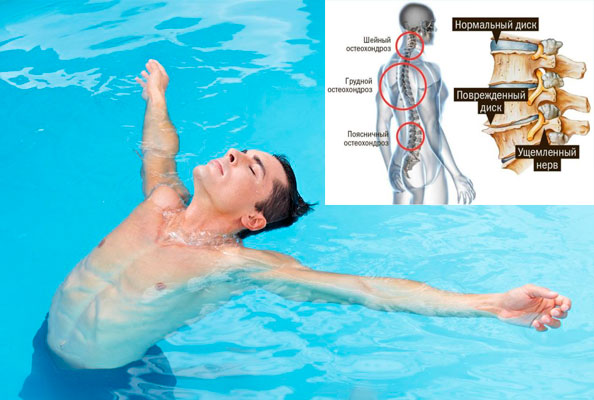 Болит спина можно ли ходить в бассейн
